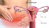 Local Business Fibroid Surgery cost in India in Panaji 