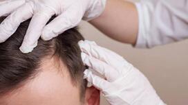 Understanding Hair Loss: Insights from a Hair Loss Specialist