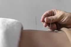 Acupuncture Therapy Florida