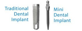 Mini Dental Implants