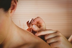 Acupuncture Therapy Florida