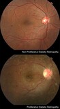 Diabetic Retinopathy