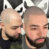 Scalp Micropigmentation NYC