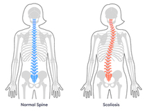 SCOLIOSIS DOCTORS