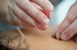 Acupuncture Therapy Florida