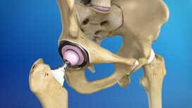 Hip Replacement Surgery: Your Path to an Active, Pain-Free Life, In Kenya