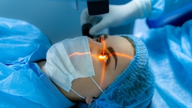 Lasik Smile