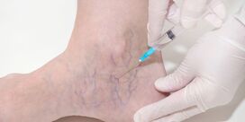 Best Sclerotherapy Treatment For Varicose And Spider veins In Union City | Advanced Medical Group