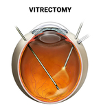 Vitrectomy