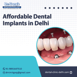 Affordable Dental Implants in Delhi