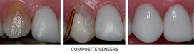 PORCELAIN DENTAL VENEERS IN DOWNTOWN MANHATTAN