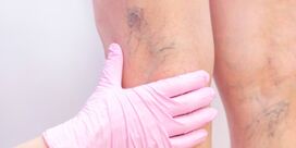 Best Spider Vein Treatment In Union City | Advanced Medical Group