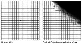 Retinal Detachment Surgery