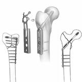 CE-Certified Orthopaedic Implants