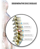 Lumbar spine degenerative joint disease NJ