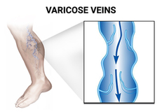 Varicose Veins Removal